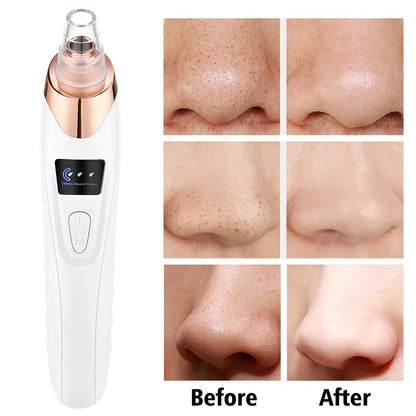 Electric Vacuum Facial Blackhead remover